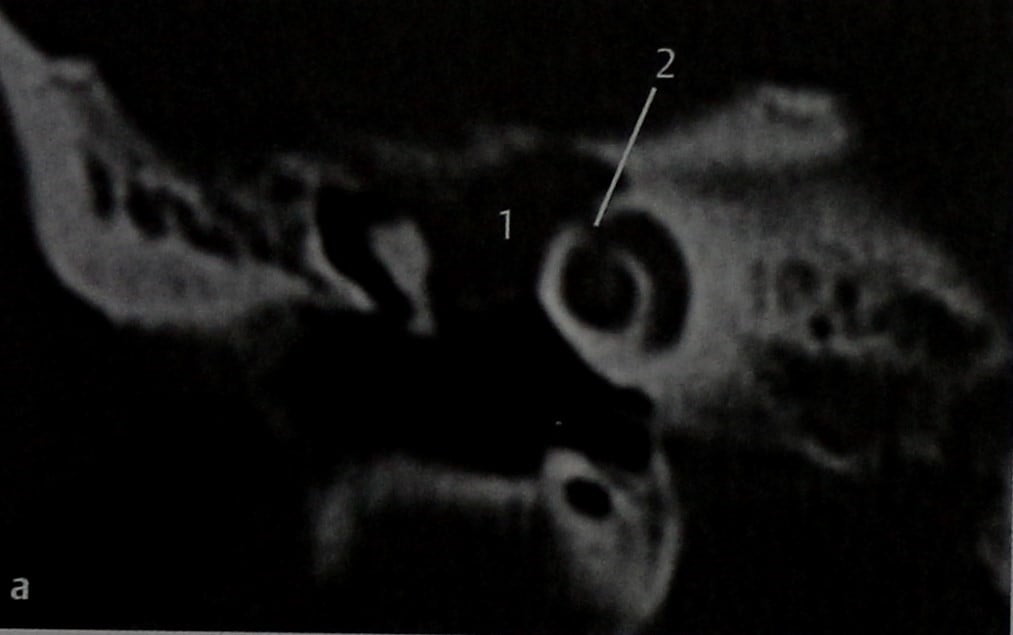 Снимки МРТ и КТ. Шваннома лицевого нерва