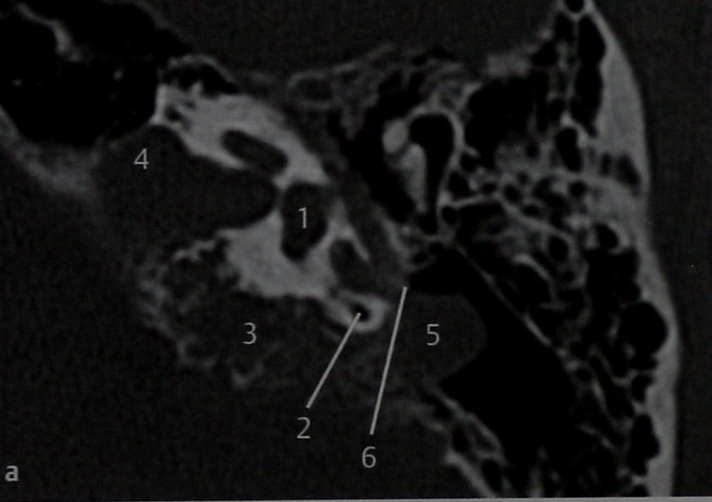 Снимки МРТ и КТ. Опухоль эндолимфатического мешка