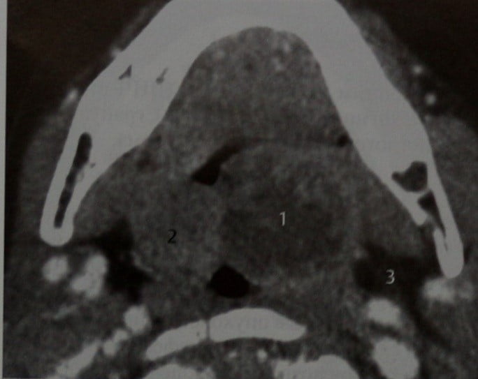 Снимки МРТ и КТ. Тонзиллярный абсцесс