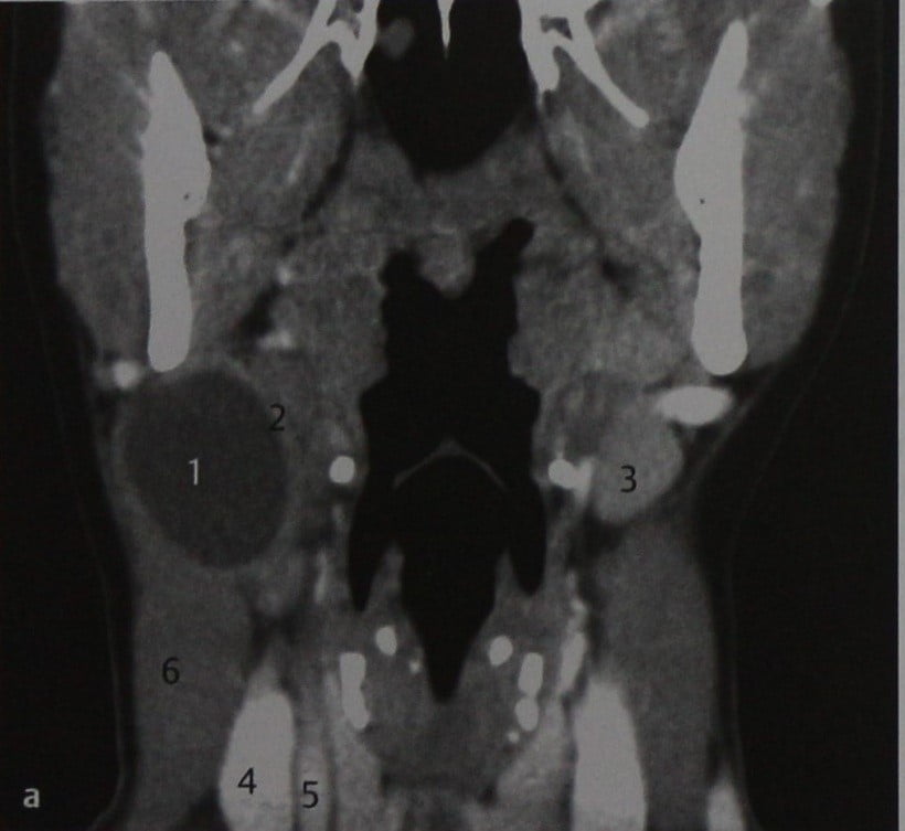Снимки МРТ и КТ. Бранхиогенная (боковая) киста шеи