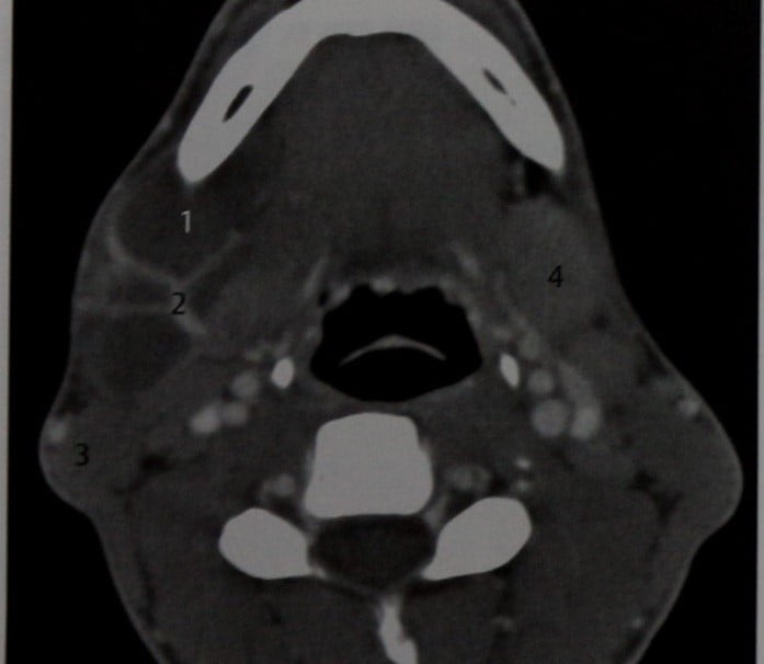 Снимки МРТ и КТ. Кистозная гигрома, лимфангиома