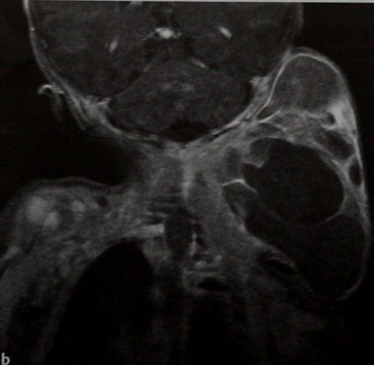 Снимки МРТ и КТ. Кистозная гигрома, лимфангиома