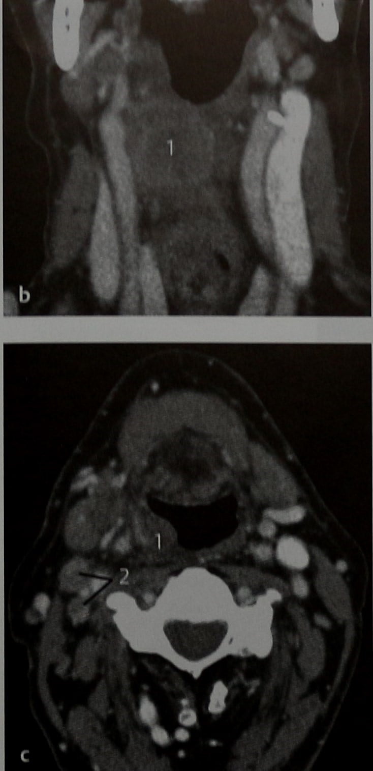Снимки МРТ и КТ. Множественные злокачественные поражения