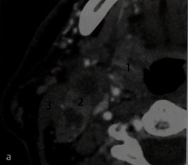 Снимки МРТ и КТ. Неходжкинские лимфомы