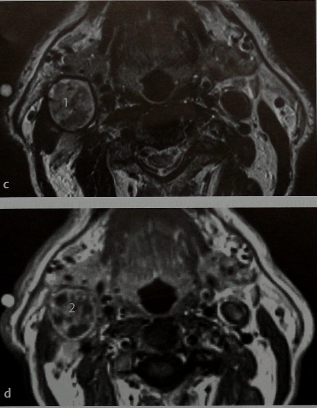Снимки МРТ и КТ. Неходжкинские лимфомы