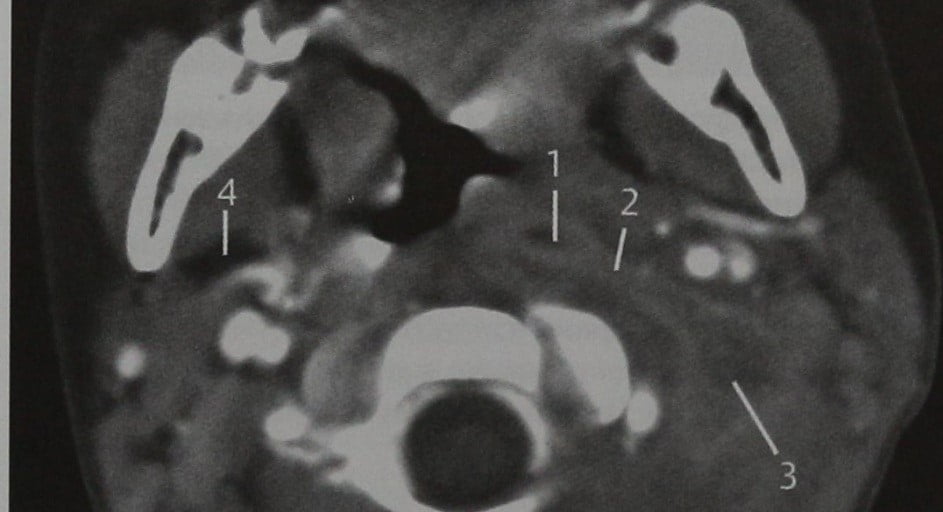 Снимки МРТ и КТ. Окологлоточный абсцесс