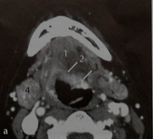 Снимки МРТ и КТ. Опухоли ротоглотки и корня языка