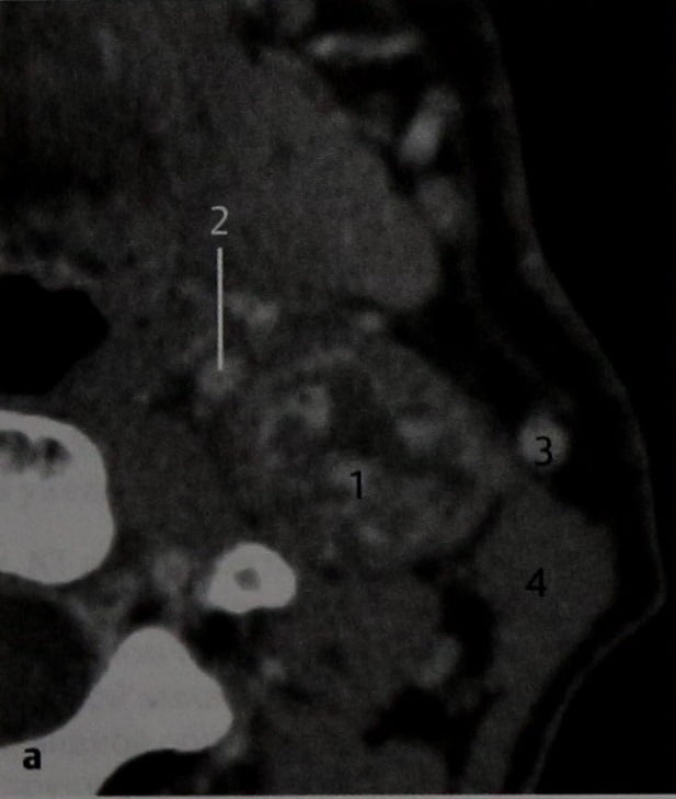 Снимки МРТ и КТ. Параганглиома каротидного тела