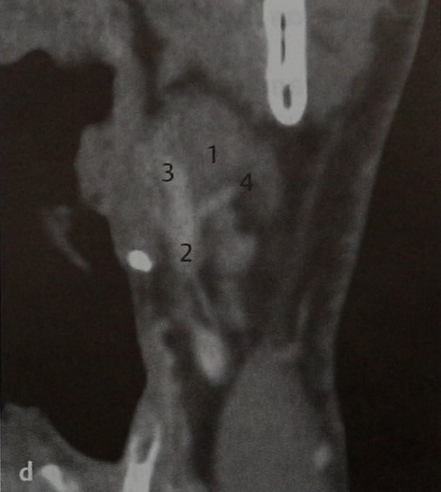 Снимки МРТ и КТ. Параганглиома каротидного тела