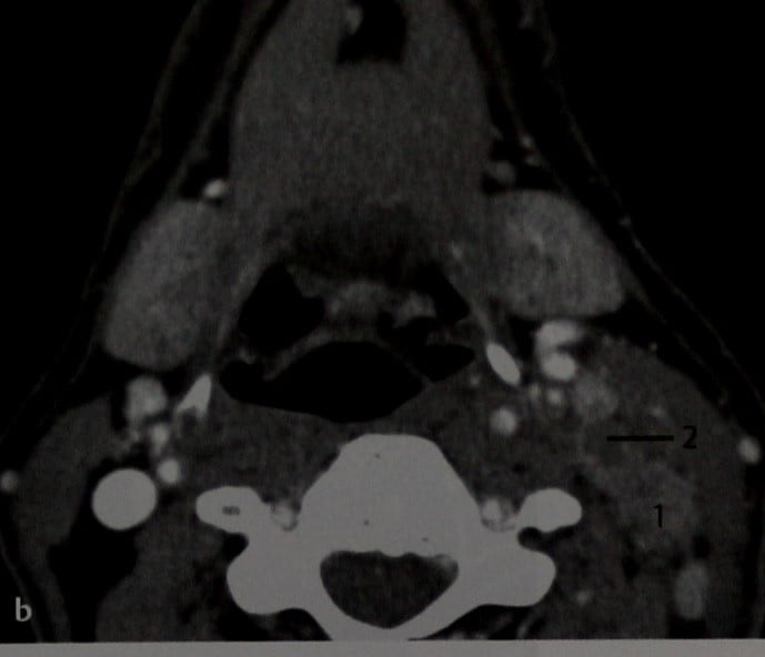 Снимки МРТ и КТ. Рак нёбной миндалины