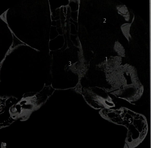 Снимки МРТ и КТ. Менингиома, сопровождающаяся деструкцией черепа
