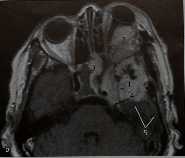 Снимки МРТ и КТ. Менингиома, сопровождающаяся деструкцией черепа