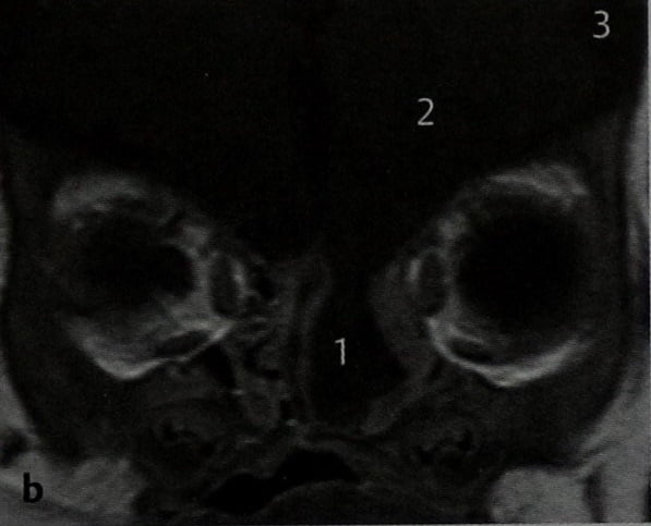 Снимки МРТ и КТ. Менингоэнцефалоцеле