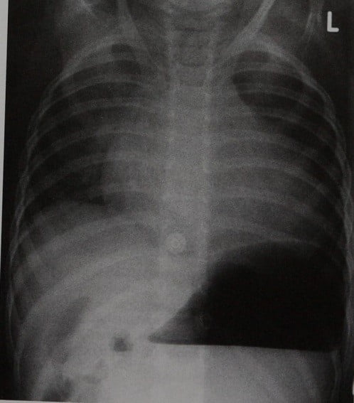 Снимки МРТ и КТ. Паралич возвратного гортанного нерва