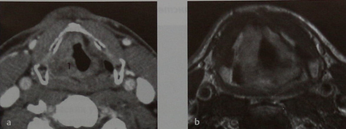Снимки МРТ и КТ. Опухоли надскладочного пространства и глотки