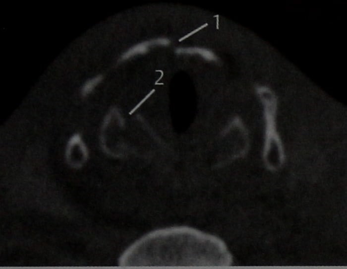 Снимки МРТ и КТ. Травма гортани