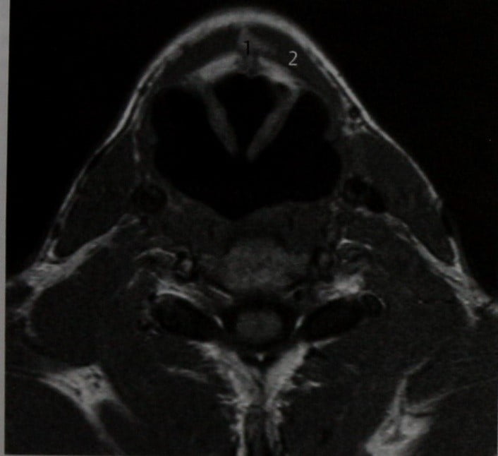 Снимки МРТ и КТ. Киста щитоязычного протока