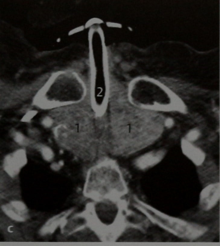 Снимки МРТ и КТ. Гипертрофия щитовидной железы и зоб