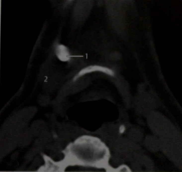 Снимки МРТ и КТ. Сиалолиты поднижнечелюстных желез