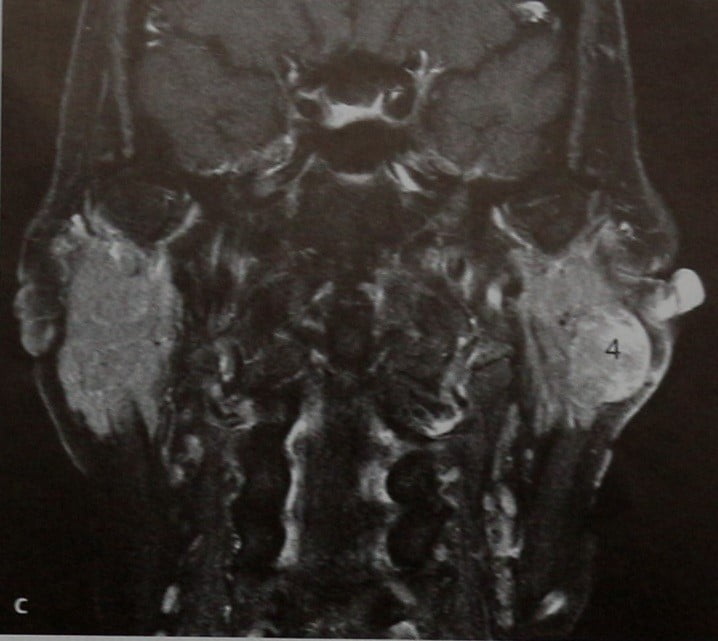 Снимки МРТ и КТ. Ацинозно-клеточная опухоль
