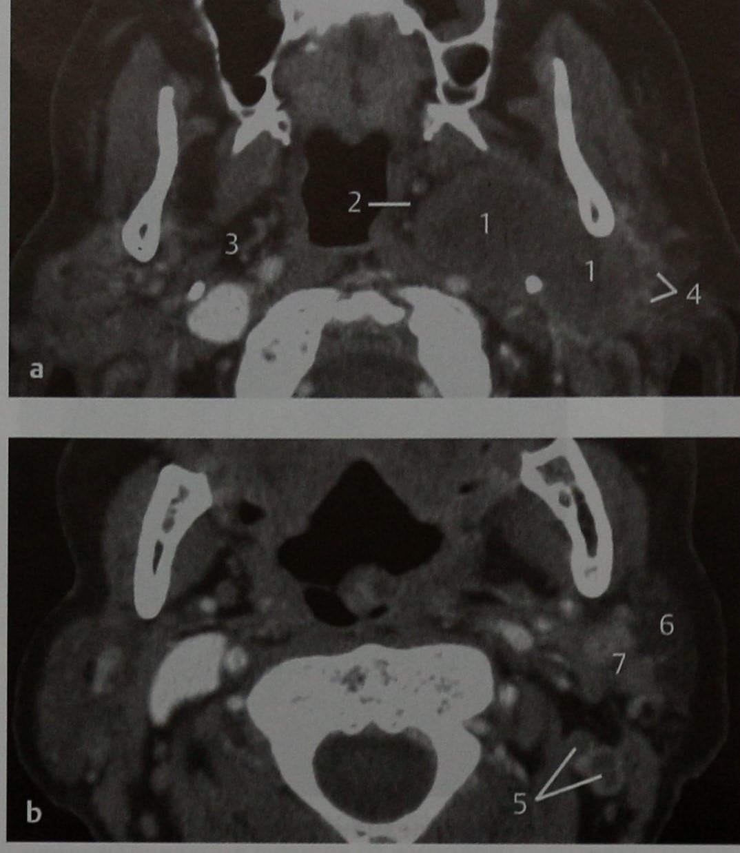 Снимки МРТ и КТ. Злокачественные опухоли околоушной железы