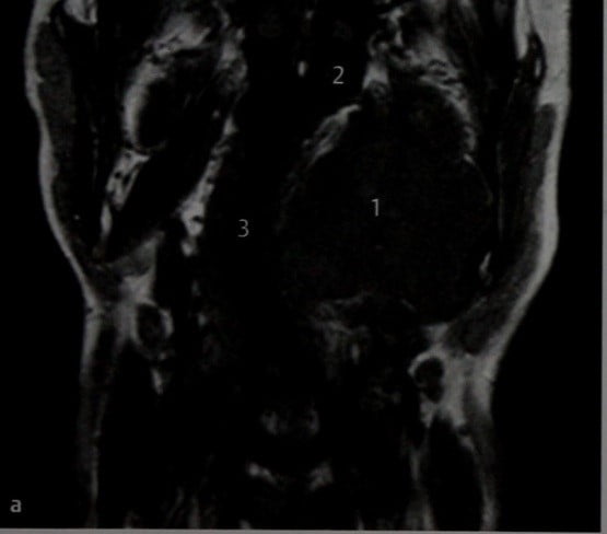 Снимки МРТ и КТ. Плеоморфная аденома околоушной железы