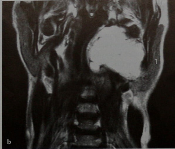 Снимки МРТ и КТ. Плеоморфная аденома околоушной железы