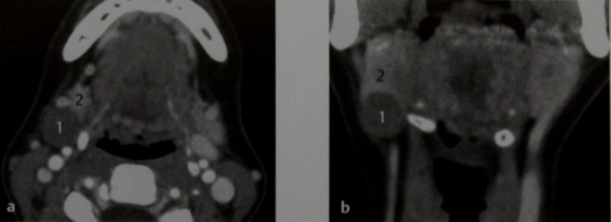 Снимки МРТ и КТ. Плеоморфная аденома поднижнечелюстной железы