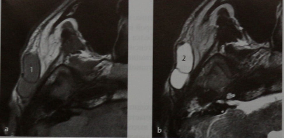 Снимки МРТ и КТ. Ранула подъязычной железы