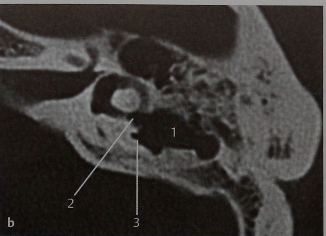 Снимки МРТ и КТ. Холестеатома, осложнившаяся образованием свища в с