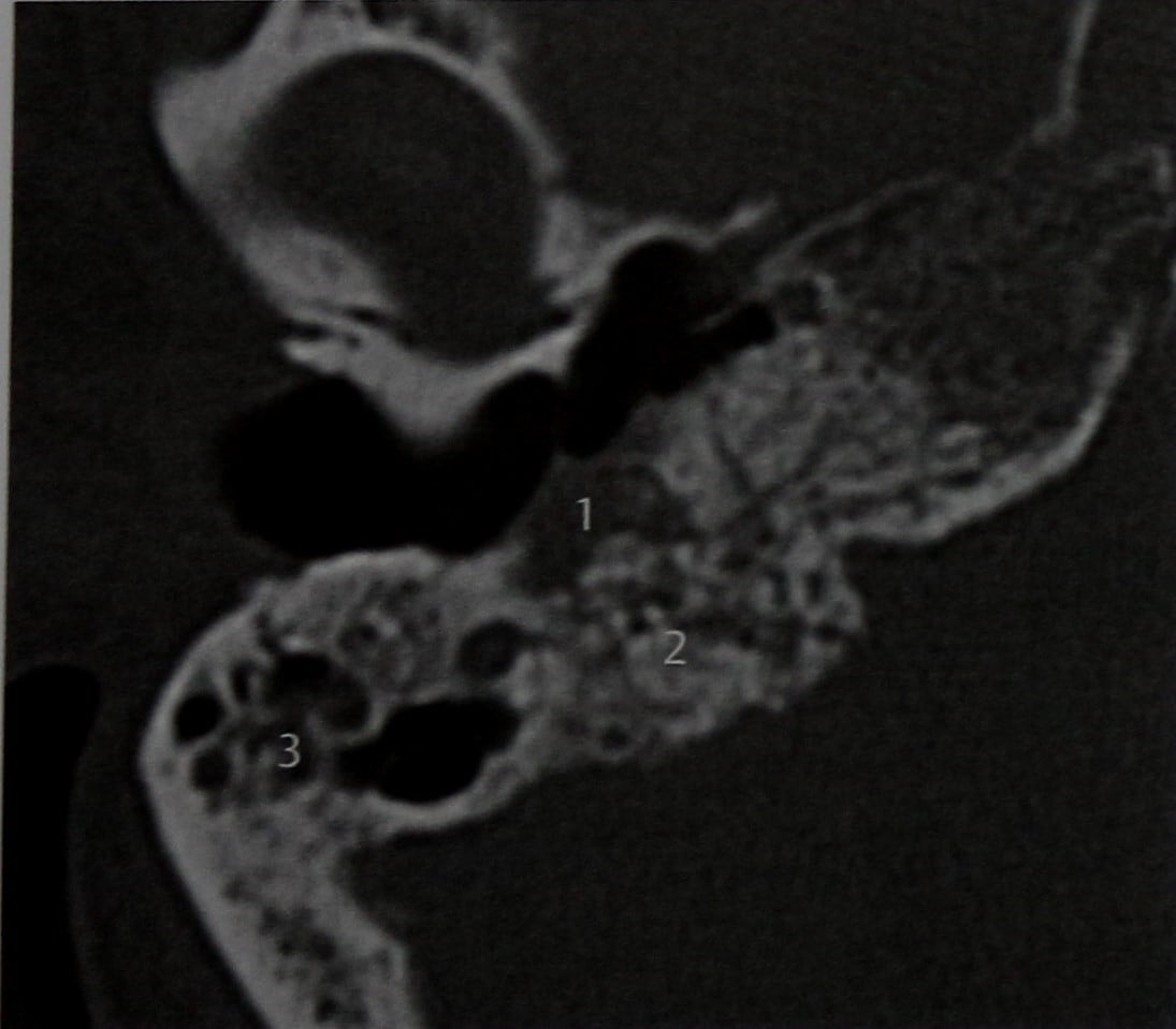 Снимки МРТ и КТ. Лучевой остеонекроз