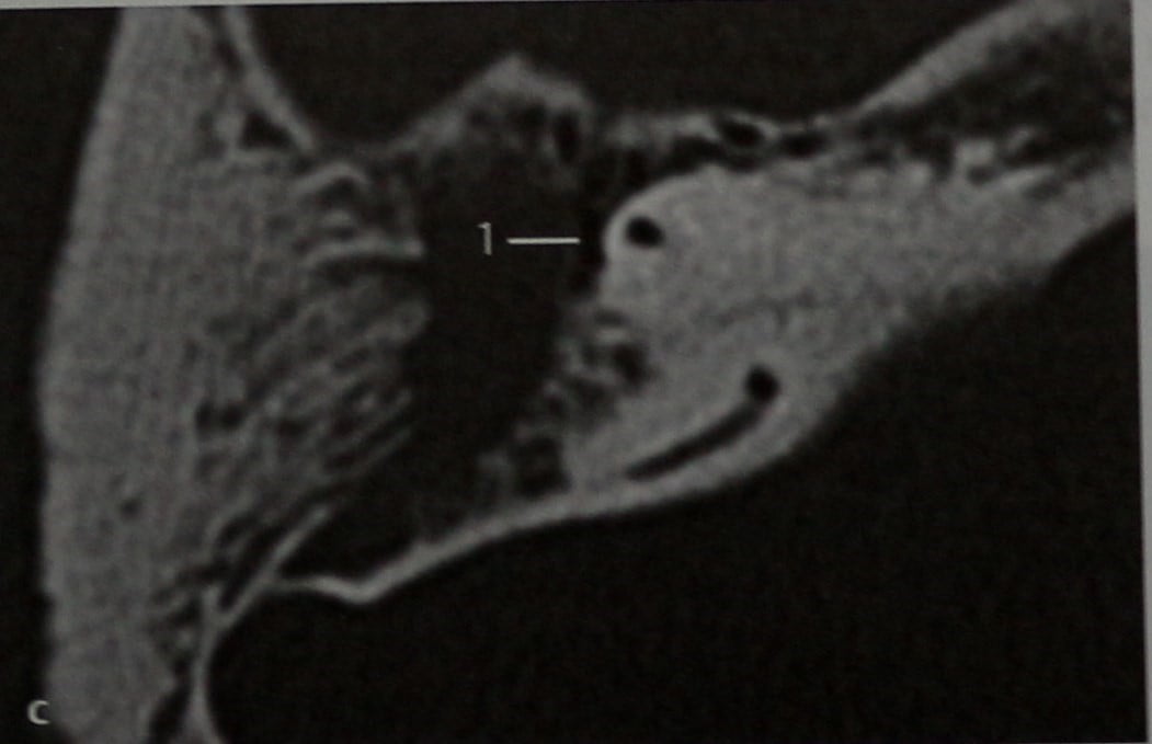 Снимки МРТ и КТ. Холестеатома