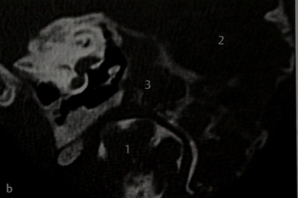 Снимки МРТ и КТ. Фиброзная дисплазия