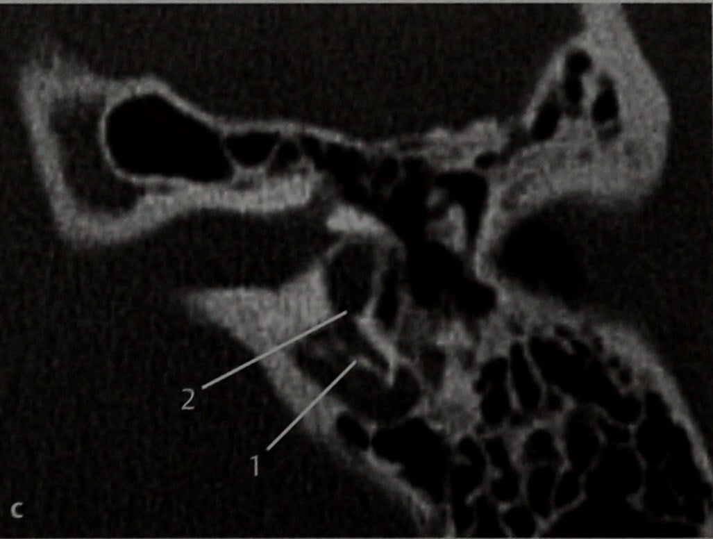 Снимки МРТ и КТ. Врожденная холестеатома