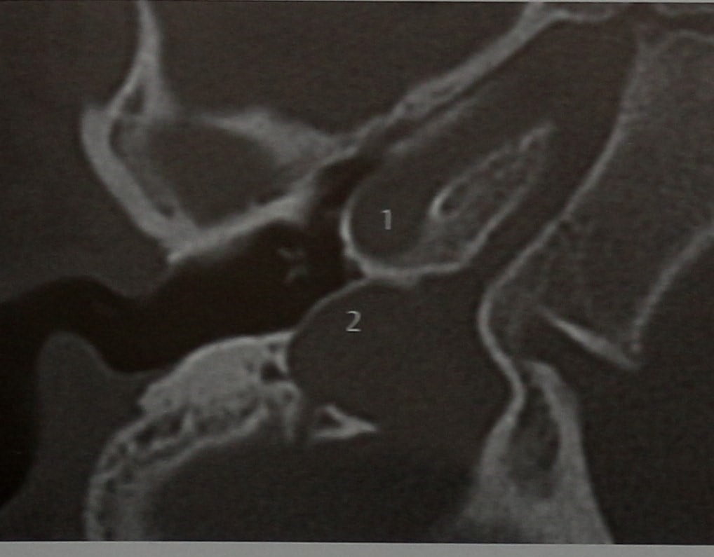 Снимки МРТ и КТ. Гломусная опухоль уха (барабанная параганглиома)
