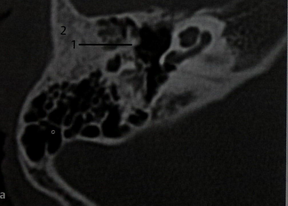 Снимки МРТ и КТ. Анкилоз слуховых косточек