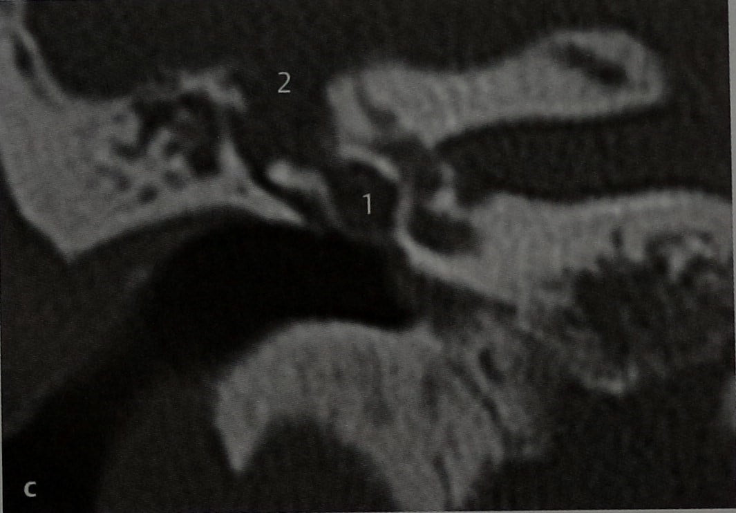 Снимки МРТ и КТ. Анкилоз слуховых косточек