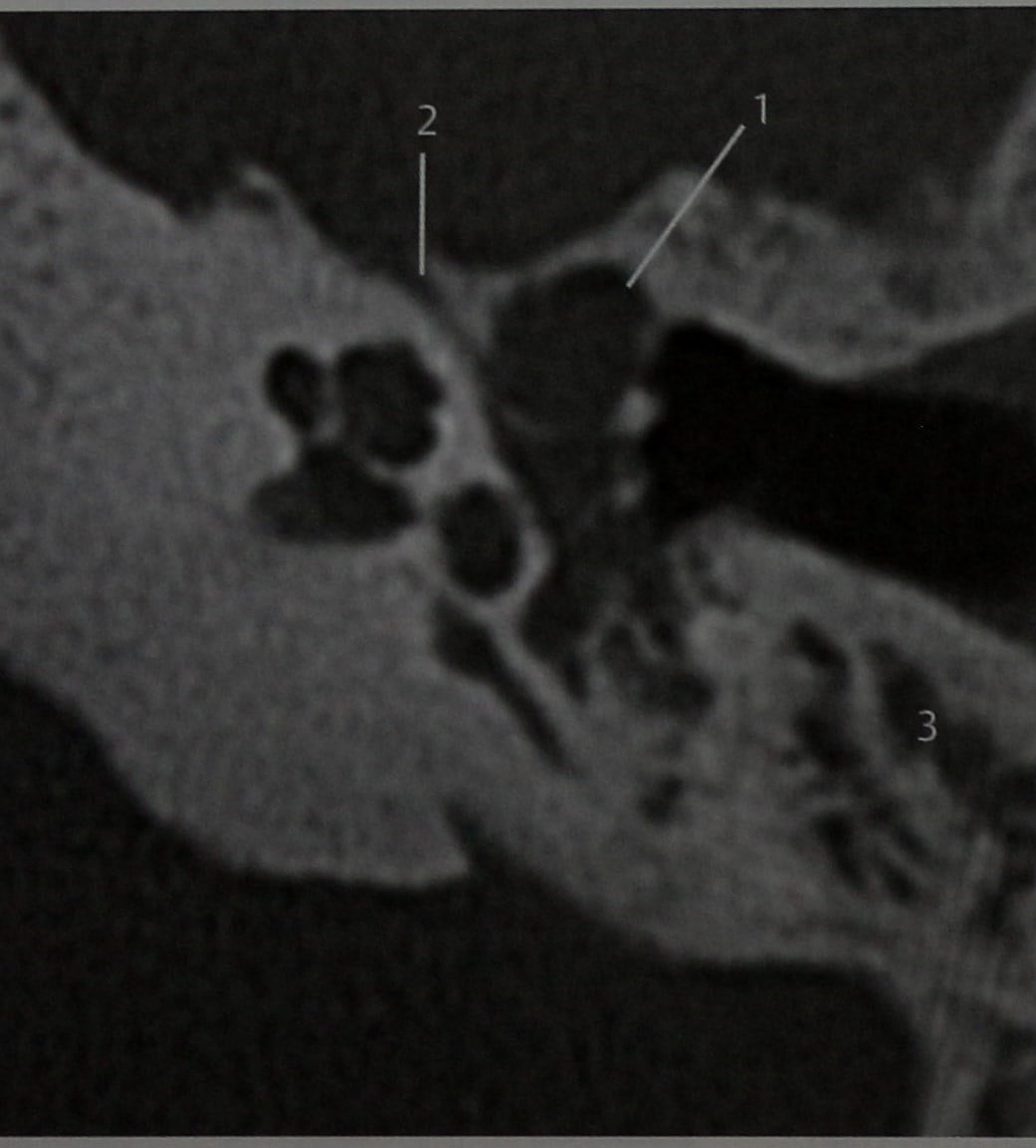 Снимки МРТ и КТ. Холестеатома среднего уха