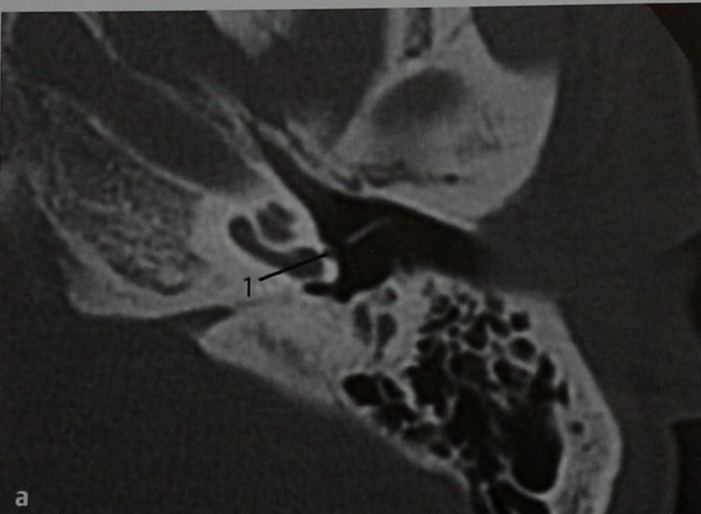 Снимки МРТ и КТ. Персистирующая артерия