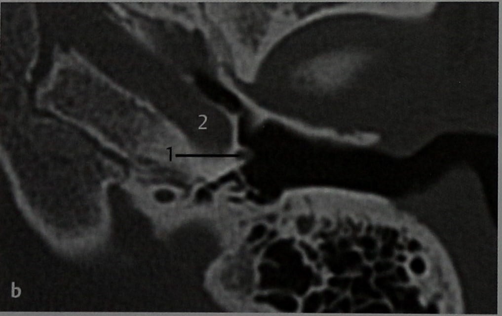 Снимки МРТ и КТ. Персистирующая артерия