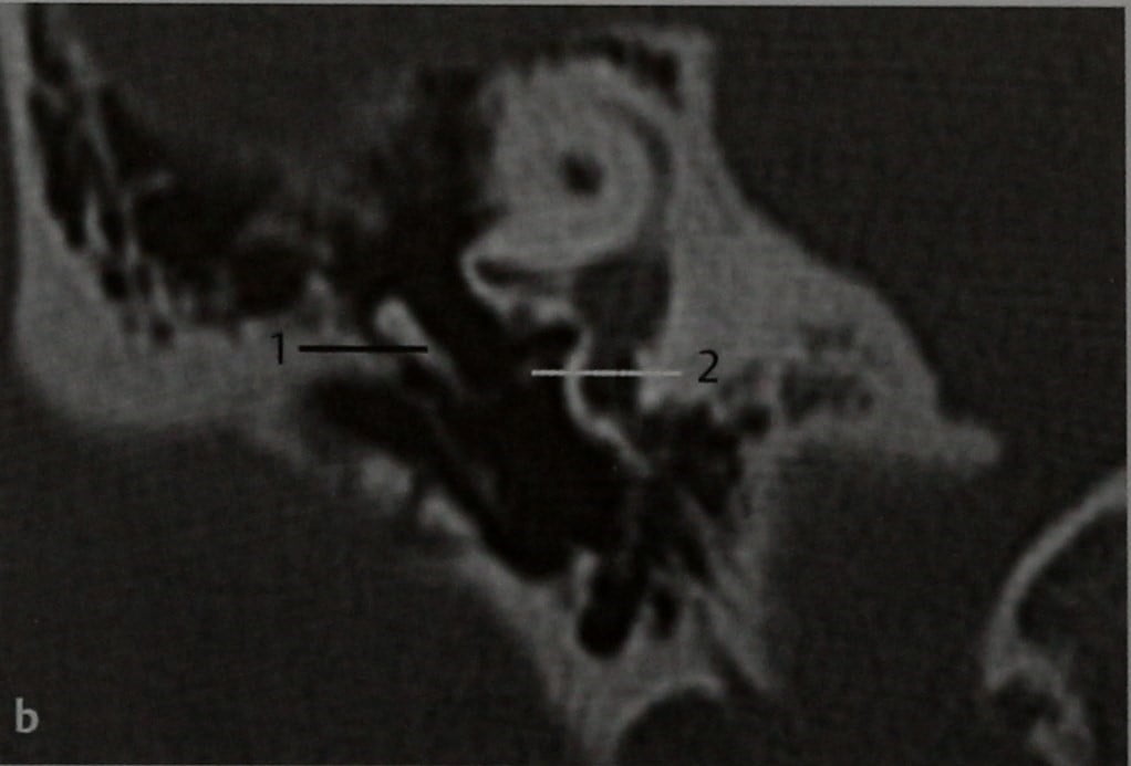 Снимки МРТ и КТ. Вывих слуховых косточек
