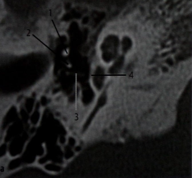 Снимки МРТ и КТ. Стапедэктомия, контроль положения протеза стремечк