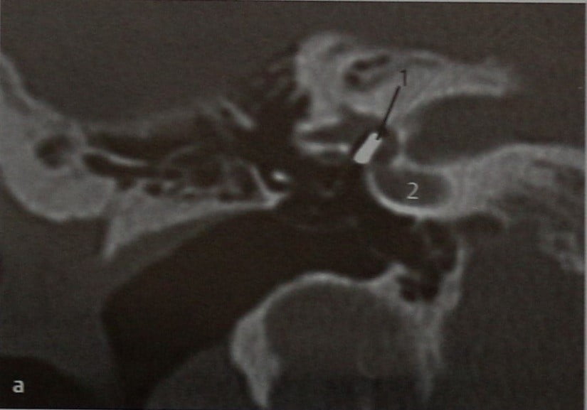 Снимки МРТ и КТ. Стапедэктомия, контроль положения протеза стремечк
