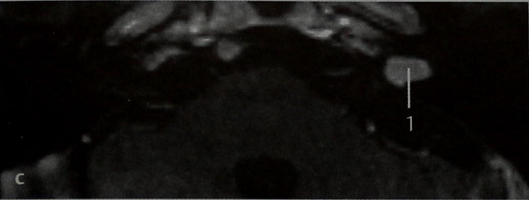 Снимки МРТ и КТ. Шваннома внутреннего слухового прохода
