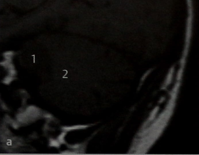 Снимки МРТ и КТ. Кистозное перерождение шванномы 