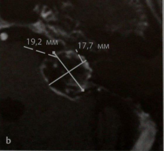 Снимки МРТ и КТ. Кистозное перерождение шванномы 