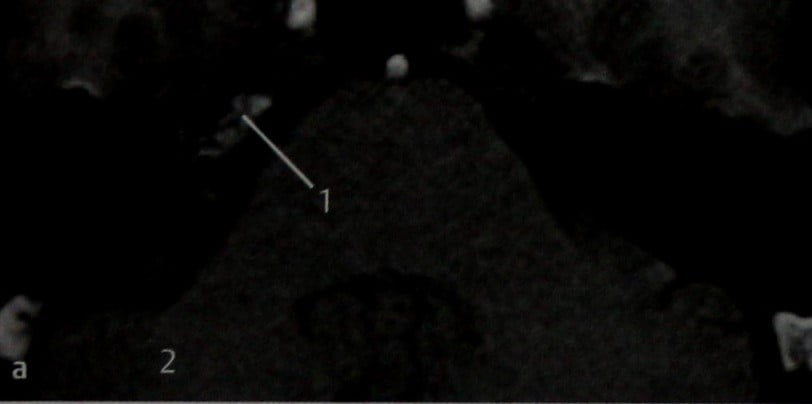 Снимки МРТ и КТ. Псевдотумор верхушки пирамиды височной кости