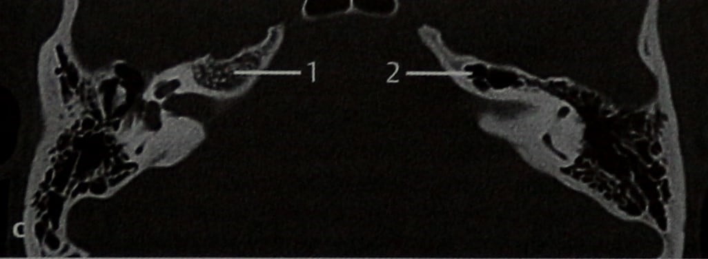 Снимки МРТ и КТ. Псевдотумор верхушки пирамиды височной кости