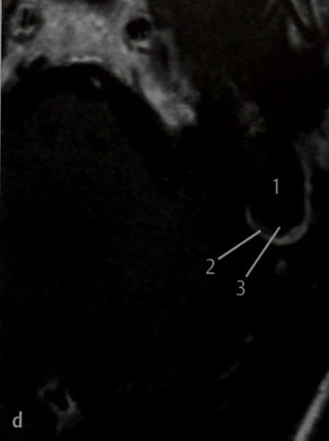 Снимки МРТ и КТ. Холестеатома, распространяющаяся в полость черепа