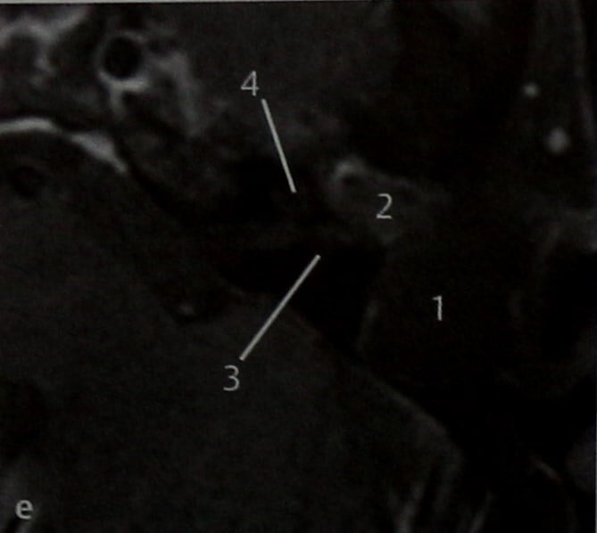 Снимки МРТ и КТ. Холестеатома, распространяющаяся в полость черепа